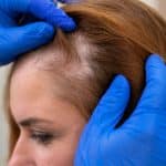 Diffuser Haarausfall Frau