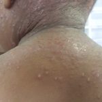 Eczema herpeticum