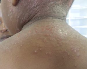 Eczema herpeticum