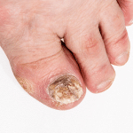 Nagelpilz Fuß