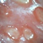 Genitalherpes