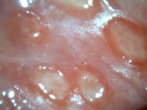 Genitalherpes
