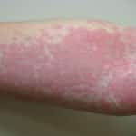 Nesselsucht am Arm