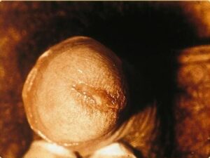 Chlamydia Ausfluss Mann
