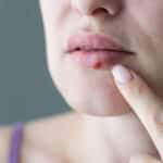 Herpes Lippe