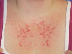 Blasenbildung als Symptom von Sonnenallergie am Dekolleté