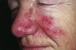 Papeln bei Rosacea