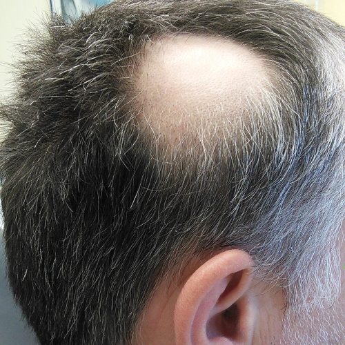 Kreisrunder Haarausfall beim Mann