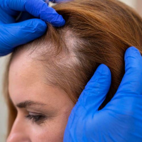 Diffuser Haarausfall Frau