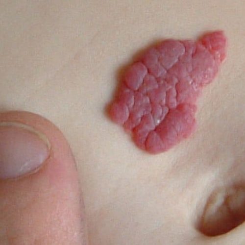Blutschwämmchen am Bauch