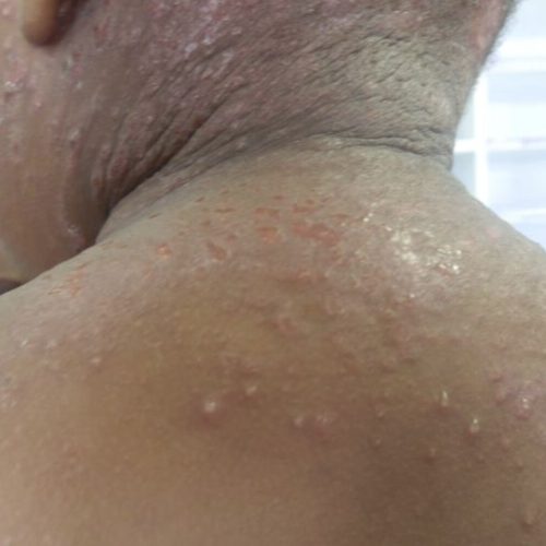 Eczema herpeticum