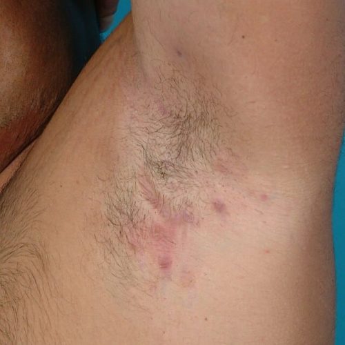 Hidradenitis suppurativa in der Achselhöhle.