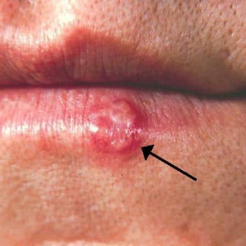 Herpes an der Lippe