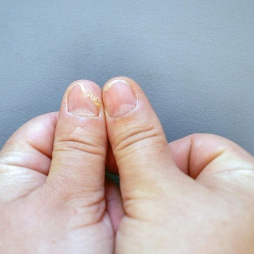 Nagelpilz Finger