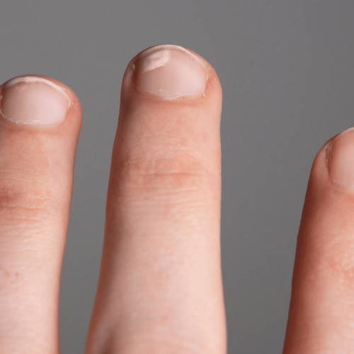 Nagelpilz Finger