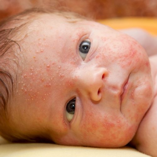 Acne neonatorum