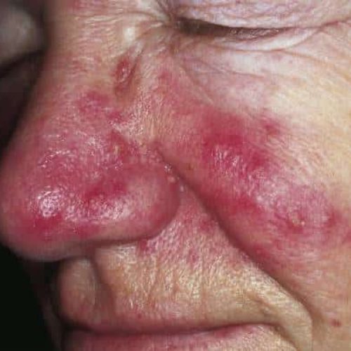 Papeln bei Rosacea
