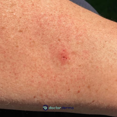 Borreliose
