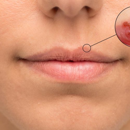 Lippenherpes
