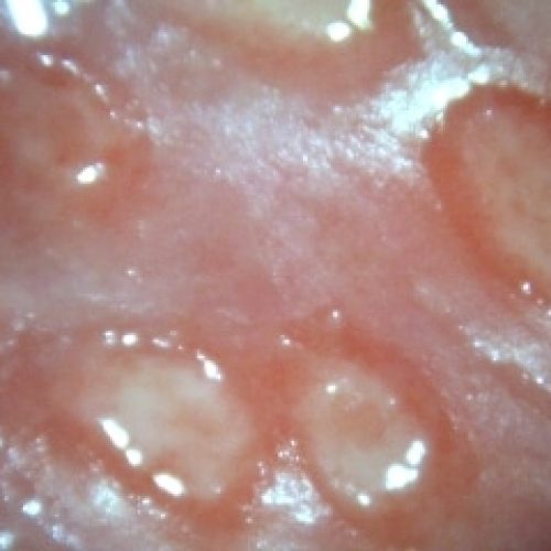 Genitalherpes