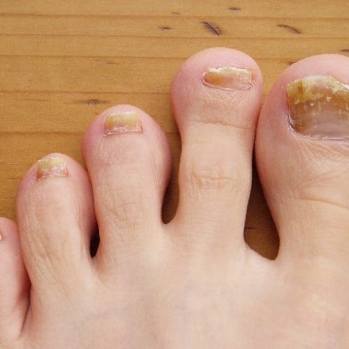 Nagelpilz am Fuß