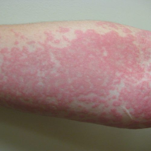 Nesselsucht am Arm